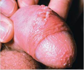 Genital Herpes - symptoms, management and treatment